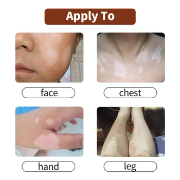 Lékařské Vitiligo Sprej Leukoplakie Onemocnění Repair Liquid Dermalight Léčba Vitiligo Podpora Kožní Pigment Melanin Péče