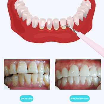 Elektrické Ultrazvukové Sonic Zubní Scaler Pocet Zubu Remover Čistší Zubní Skvrny Tatarská Nástroj, Vybělit Zuby, Odstranit Zubní Kámen